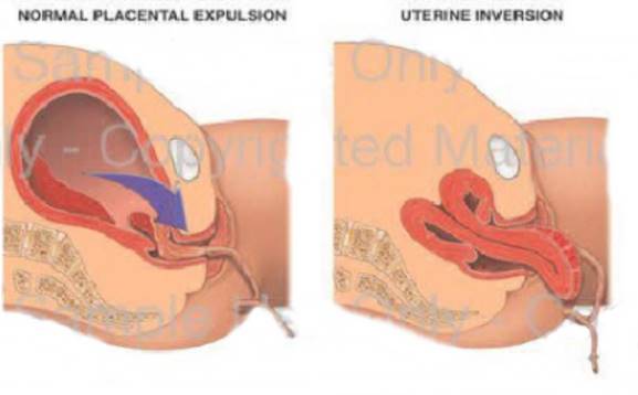 gambar inversio uteri