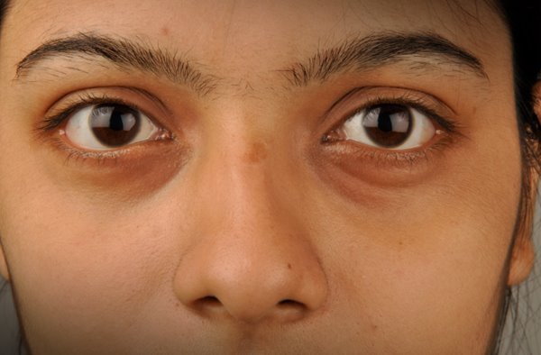 Cara Tuntas Menghilangkan Kantung Mata dan Mencegahnya - Aladokter
