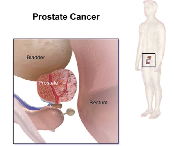 gejala kanker prostat 